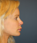 Feel Beautiful - Revision Rhinoplasty 82 - After Photo